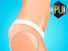 Causes and Preventions of Stretch Marks www.21e645788a.nxcli.net/Stretch Marks Causes and Preventions