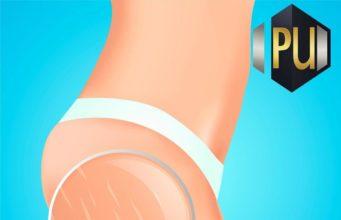 Causes and Preventions of Stretch Marks www.21e645788a.nxcli.net/Stretch Marks Causes and Preventions