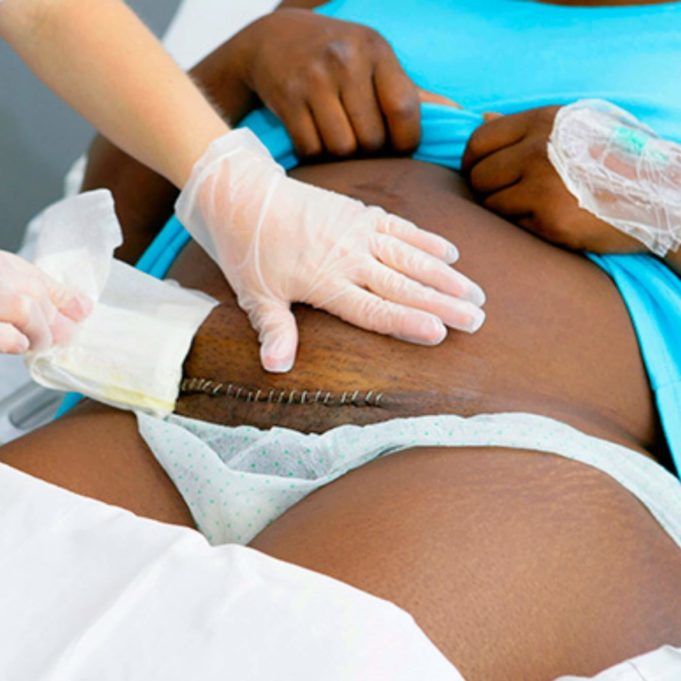 A Short Story About C-Section www.21e645788a.nxcli.net/C SECTION
