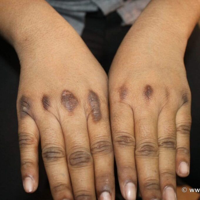 How to Get Rid of Dark Knuckles How to Get Rid of Dark Knuckles