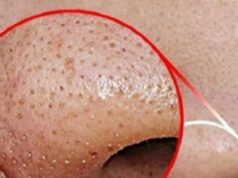 How to Get Rid of Whiteheads 6 Natural Ways to get Rid of Whitehead's on the Nose