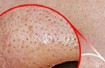 How to Get Rid of Whiteheads 6 Natural Ways to get Rid of Whitehead's on the Nose