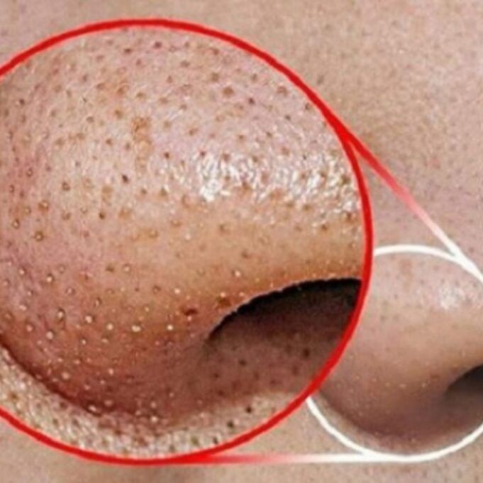 How to Get Rid of Whiteheads 6 Natural Ways to get Rid of Whitehead's on the Nose