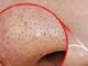 How to Get Rid of Whiteheads 6 Natural Ways to get Rid of Whitehead's on the Nose