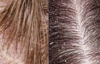 Home Treatment for Dandruff Home Treatment for Dandruff