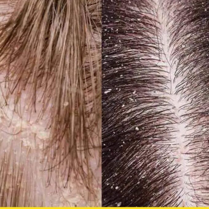 Home Treatment for Dandruff Home Treatment for Dandruff