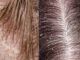 Home Treatment for Dandruff Home Treatment for Dandruff