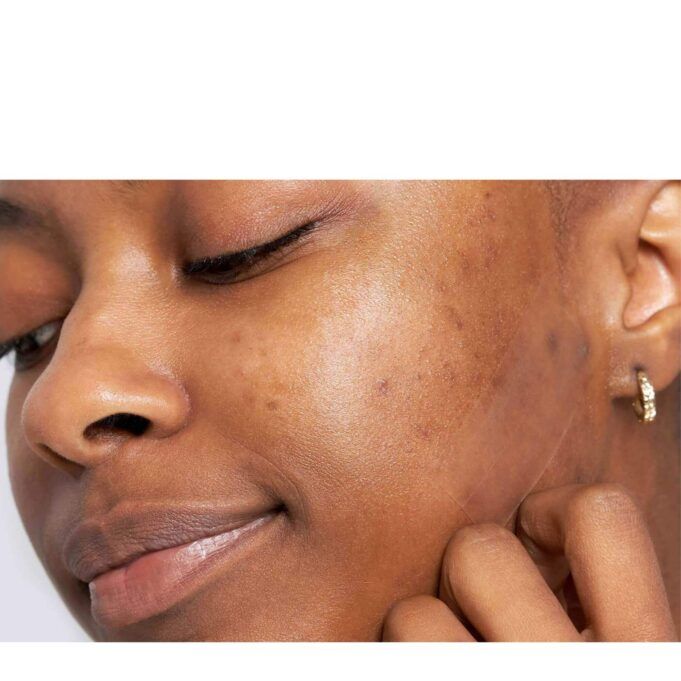 How To Get Rid Of Acne Scars How To Get Rid Of Acne Scars