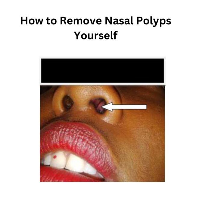 How to Remove Nasal Polyps Yourself How to Remove Nasal Polyps Yourself
