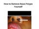 How to Remove Nasal Polyps Yourself How to Remove Nasal Polyps Yourself