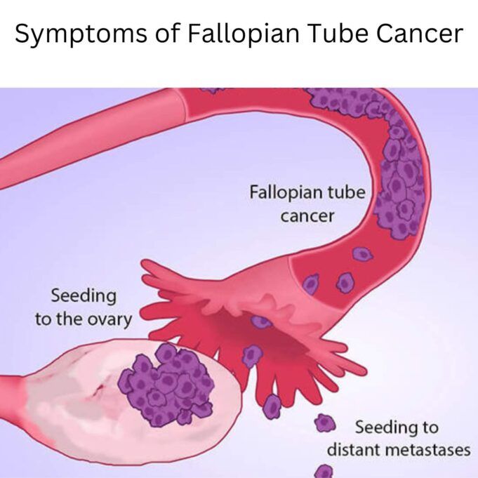 Symptoms of Fallopian Tube Cancer Symptoms of Fallopian Tube Cancer
