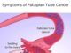 Symptoms of Fallopian Tube Cancer Symptoms of Fallopian Tube Cancer
