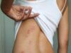 Everything You Need to Know About Bed Bugs Bites Everything You Need to Know About Bed Bugs Bites
