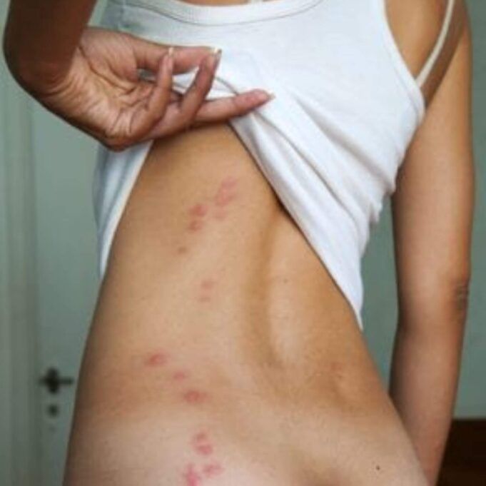 Everything You Need to Know About Bed Bugs Bites Everything You Need to Know About Bed Bugs Bites