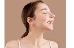 Does Groundnut Cause Pimples? All You Need To know Does Groundnut Cause Pimples