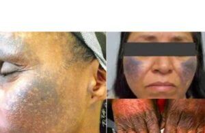 Skin Bleaching Gone Wrong. What You Should Know Skin Bleaching