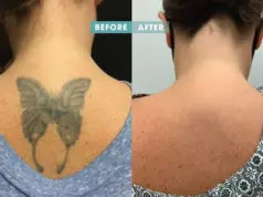 Removery Tattoo Removal & Fading: All You Need to Know removery tattoo removal