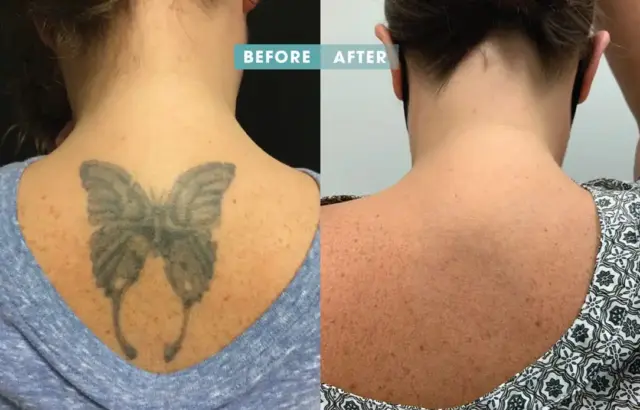 removery tattoo removal removery tattoo removal