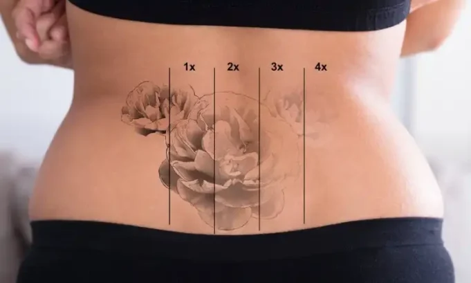 How Does Laser Tattoo Removal Work? How does laser tattoo removal work?