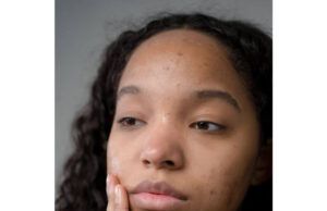 How To Get Rid Of Pimple On The Forehead Pimple On The Forehead