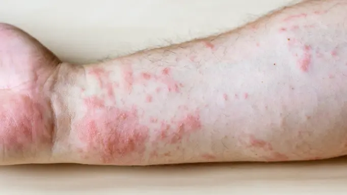Medicine For Skin Rashes And Itching Medicine For Skin Rashes And Itching