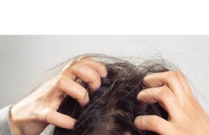 Home Remedies for Dandruff Treatment Dandruff Treatment
