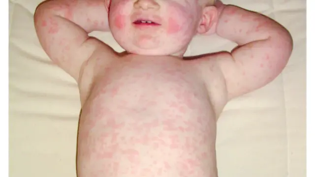 How To Treat Rashes on Baby Skin