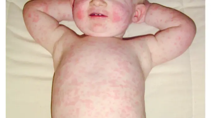 How To Treat Rashes on Baby Skin How To Treat Rashes on Baby Skin