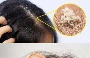 How to Remove Lice from Hair Permanently at Home How to remove lice from hair permanently at home