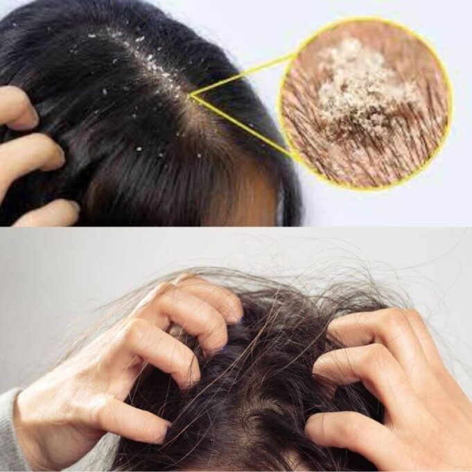 How to Remove Lice from Hair Permanently at Home How to remove lice from hair permanently at home