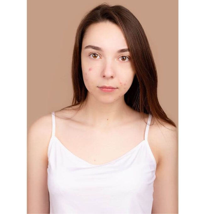 How to Remove Pimples Naturally at Home Pimples