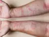 Itchy Skin Rash Remedy Itchy Skin Rash Remedy