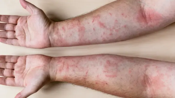 Itchy Skin Rash Remedy Itchy Skin Rash Remedy
