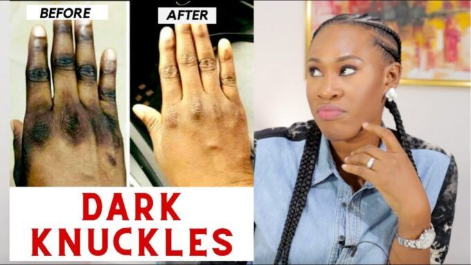 How To Lighten Dark Knuckles And Toes Naturally With Lemon Lighten Dark Knuckles And Toes Naturally With Lemon