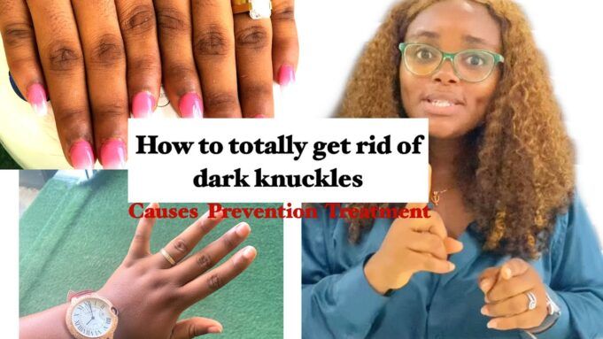 How To Get Rid of Dark Knuckles Fast And Permanently Get Rid of Dark Knuckles Fast And Permanently