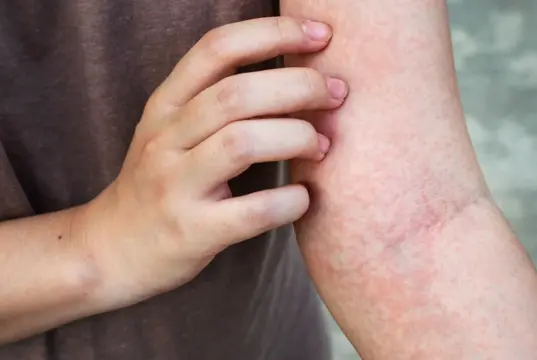 Itchy Skin Rash Remedy. What You Need To do Itchy Skin Rash Remedy