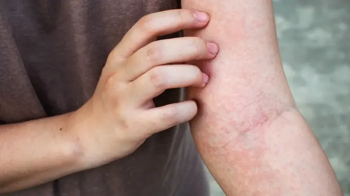 Itchy Skin Rash Remedy. What You Need To do Itchy Skin Rash Remedy