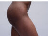 Stretch Marks Removal Cream Price Stretch Marks