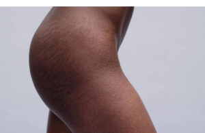 Stretch Marks Removal Cream Price Stretch Marks