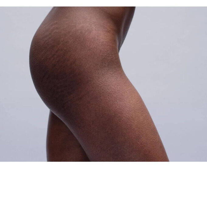 Stretch Marks Removal Cream Price Stretch Marks