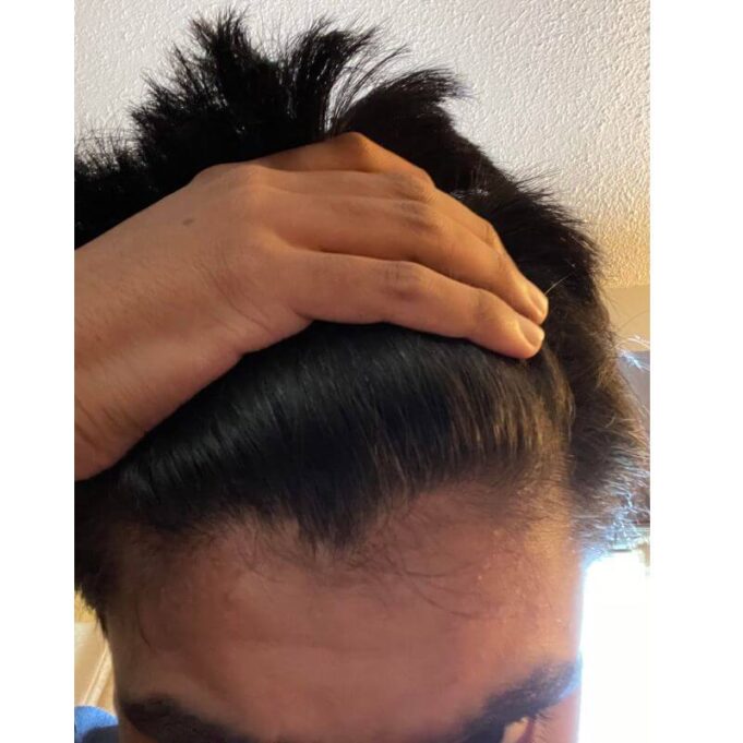 Hair Growth Cream For Receding Hairline Hair Growth Cream For Receding Hairline