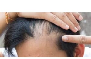 Hairline Fracture Recovery Time. Full Details Hairline Fracture Recovery