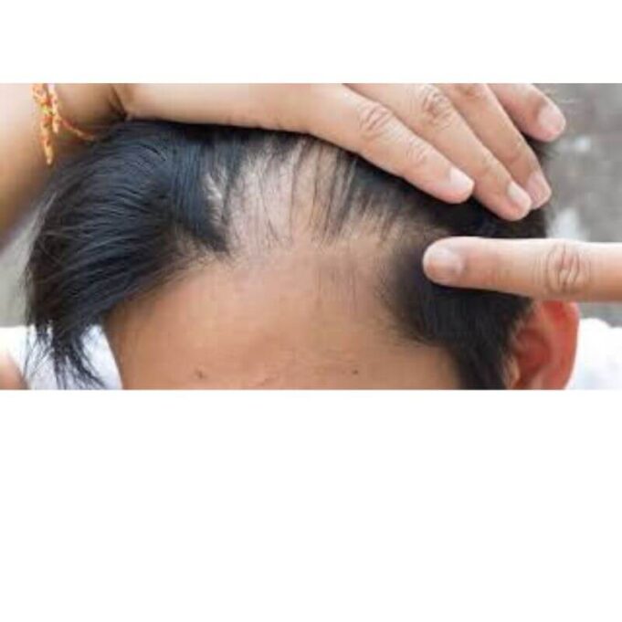 Hairline Fracture Recovery Time. Full Details Hairline Fracture Recovery