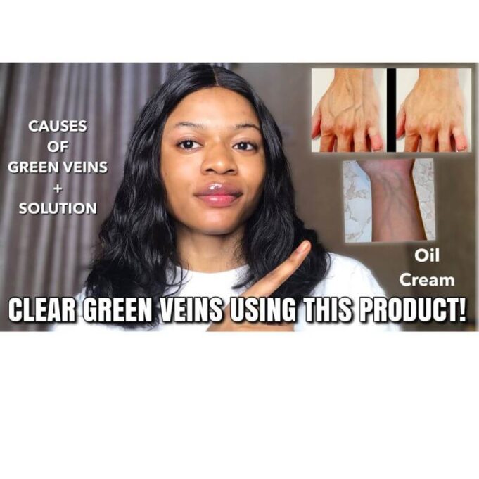 How To Get Rid Of Green Veins Caused By Bleaching How To Get Rid Of Green Veins Caused By Bleaching