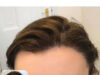 How To Treat Receding Hairline How To Regrow Your Hairline