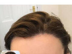 How To Treat Receding Hairline How To Regrow Your Hairline