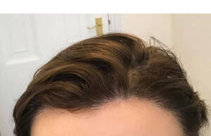 How To Treat Receding Hairline How To Regrow Your Hairline