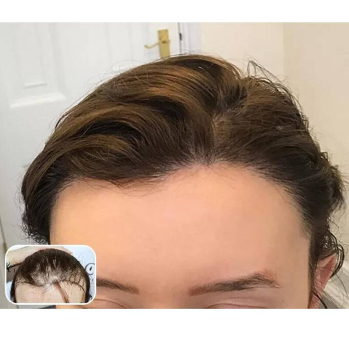 How To Treat Receding Hairline How To Regrow Your Hairline