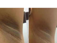 How to lighten inner thighs and armpits How to lighten inner thighs and armpits