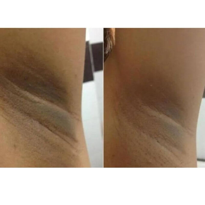 How to lighten inner thighs and armpits How to lighten inner thighs and armpits